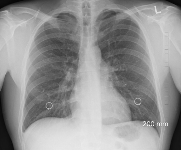 Житель Хакасии рискует остаться без лёгкого после лечения пневмонии