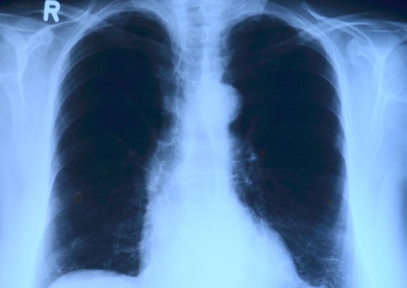 330 жителей Югры за неделю заболели воспалением лёгких
