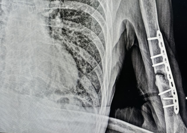 Пенсионер из ХМАО пять лет ходил со сломанным плечом после аварии