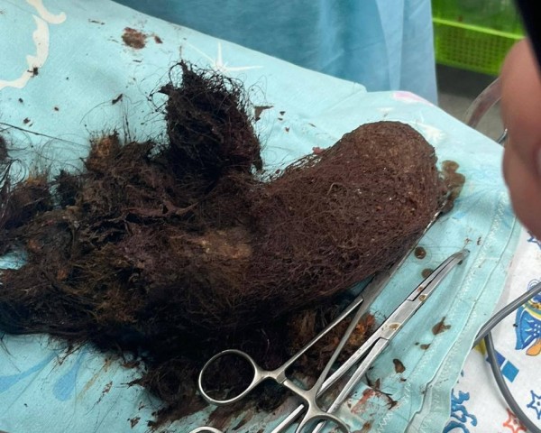 ​В ХМАО из желудка 12-летней девочки достали огромный комок волос