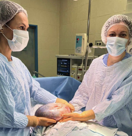 Опухоль диаметром с большую пиццу вырезали женщине в Сургуте