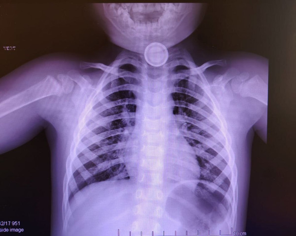 Сильный ожог вызвала проглоченная батарейка у ребенка из ХМАО