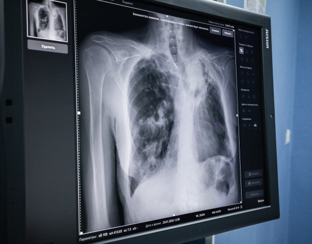 Обычная флюорография спасла жителя Сургута от смерти